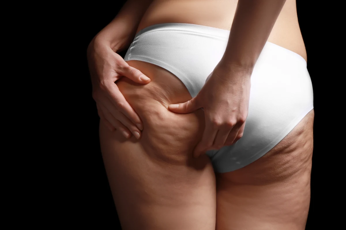 woman-with-cellulite-problem-black-background